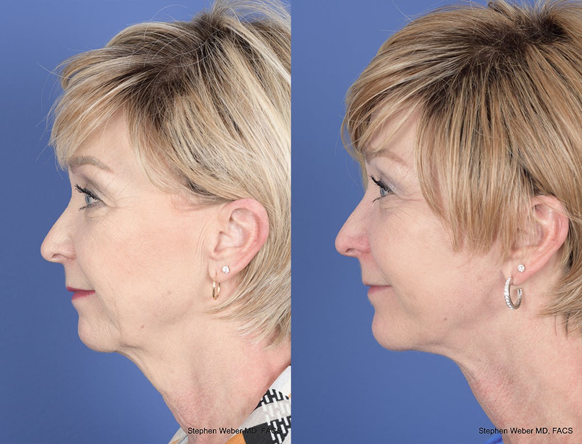 Facelift Before & After Gallery - Patient 419292 - Image 2