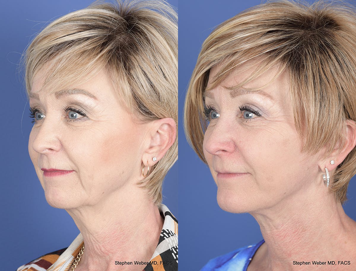 Facelift Before & After Gallery - Patient 419292 - Image 3