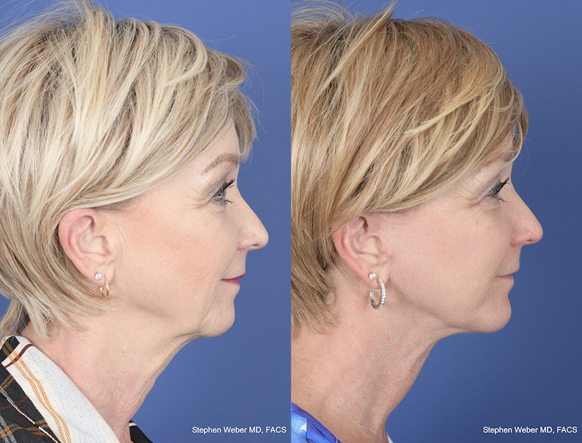 Facelift Before & After Gallery - Patient 419292 - Image 4