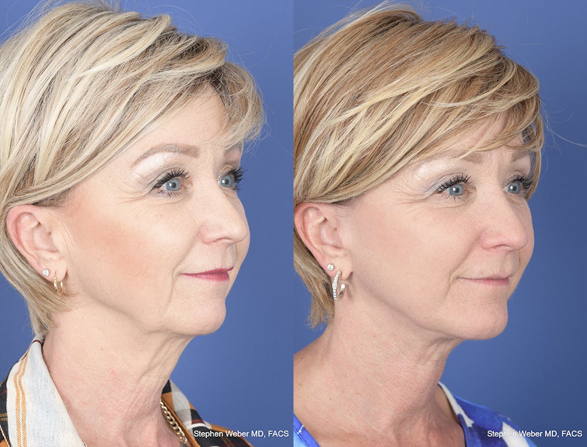Facelift Before & After Gallery - Patient 419292 - Image 5