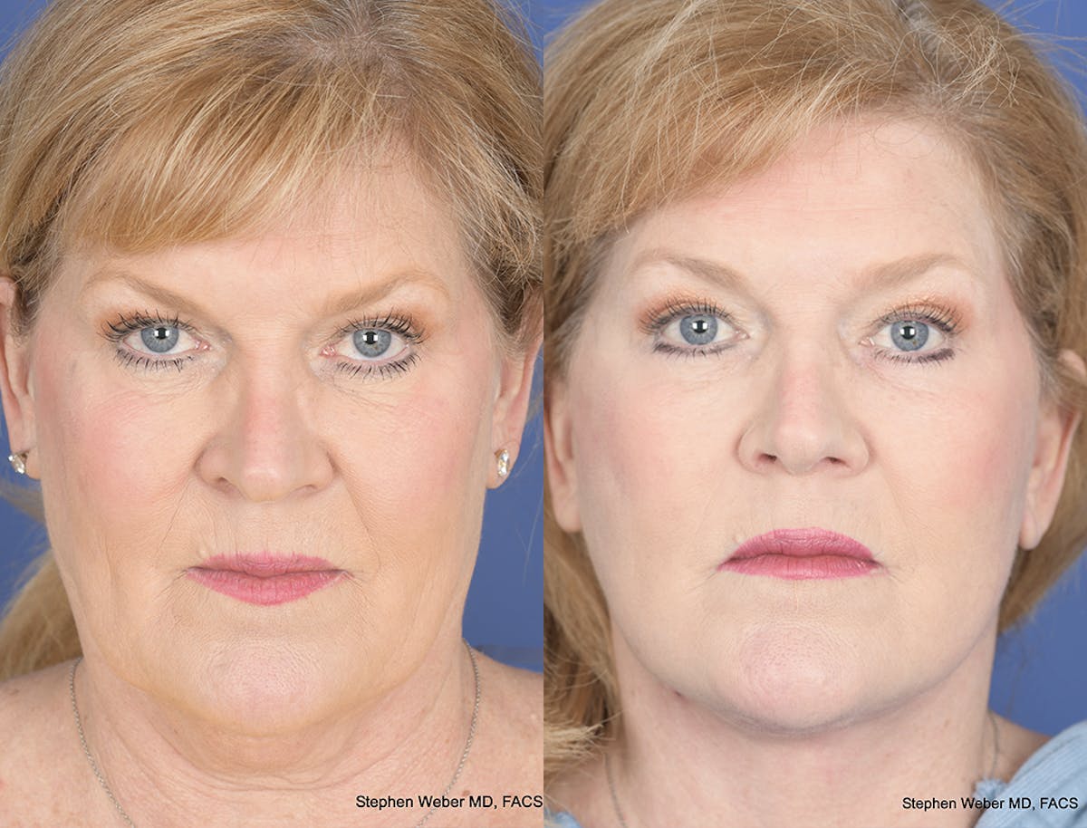 Facelift Before & After Gallery - Patient 397028 - Image 1
