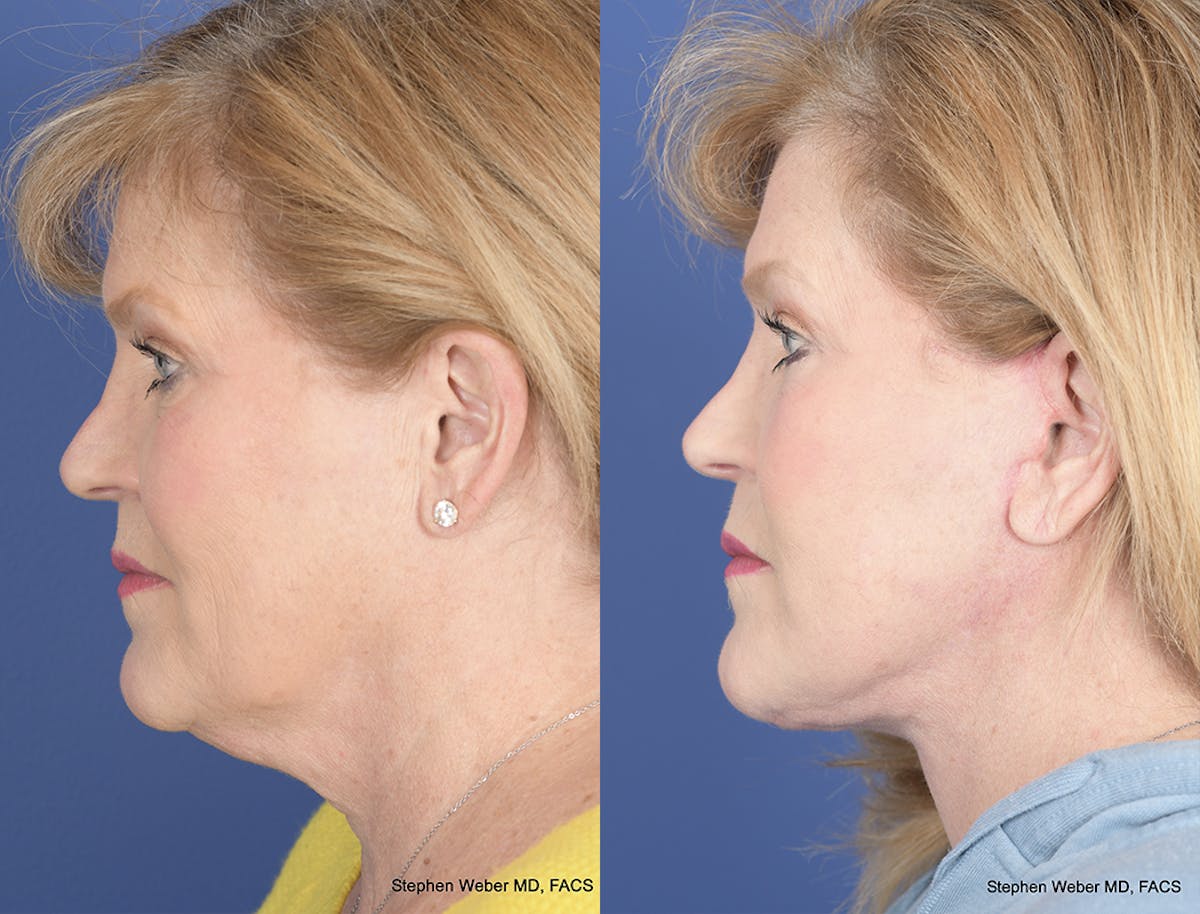 Facelift Before & After Gallery - Patient 397028 - Image 2