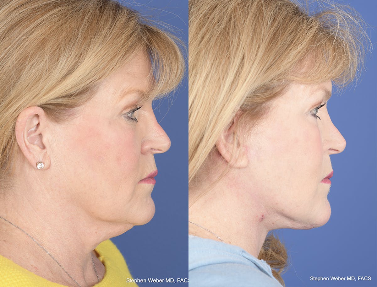 Facelift Before & After Gallery - Patient 397028 - Image 3