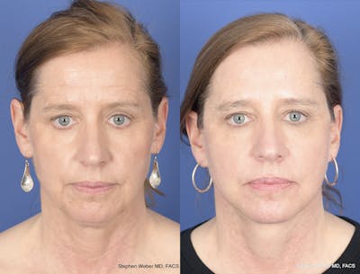 Facelift Before & After Gallery - Patient 700405 - Image 1