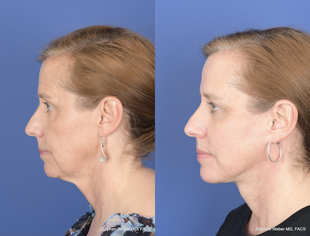 Facelift Before & After Gallery - Patient 700405 - Image 2