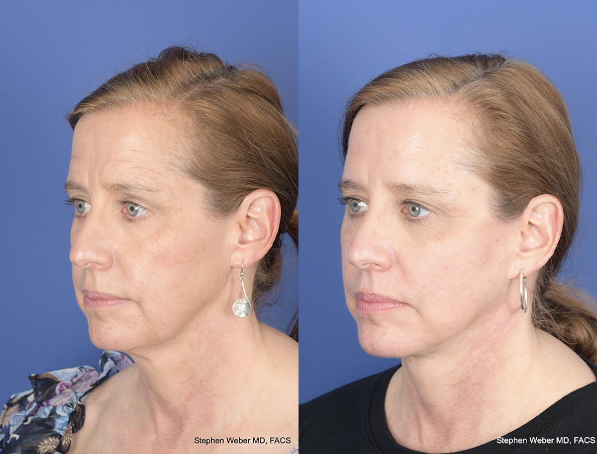 Facelift Before & After Gallery - Patient 700405 - Image 3