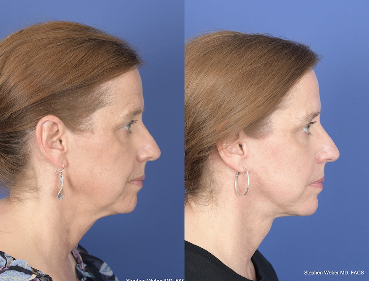 Facelift Before & After Gallery - Patient 700405 - Image 4