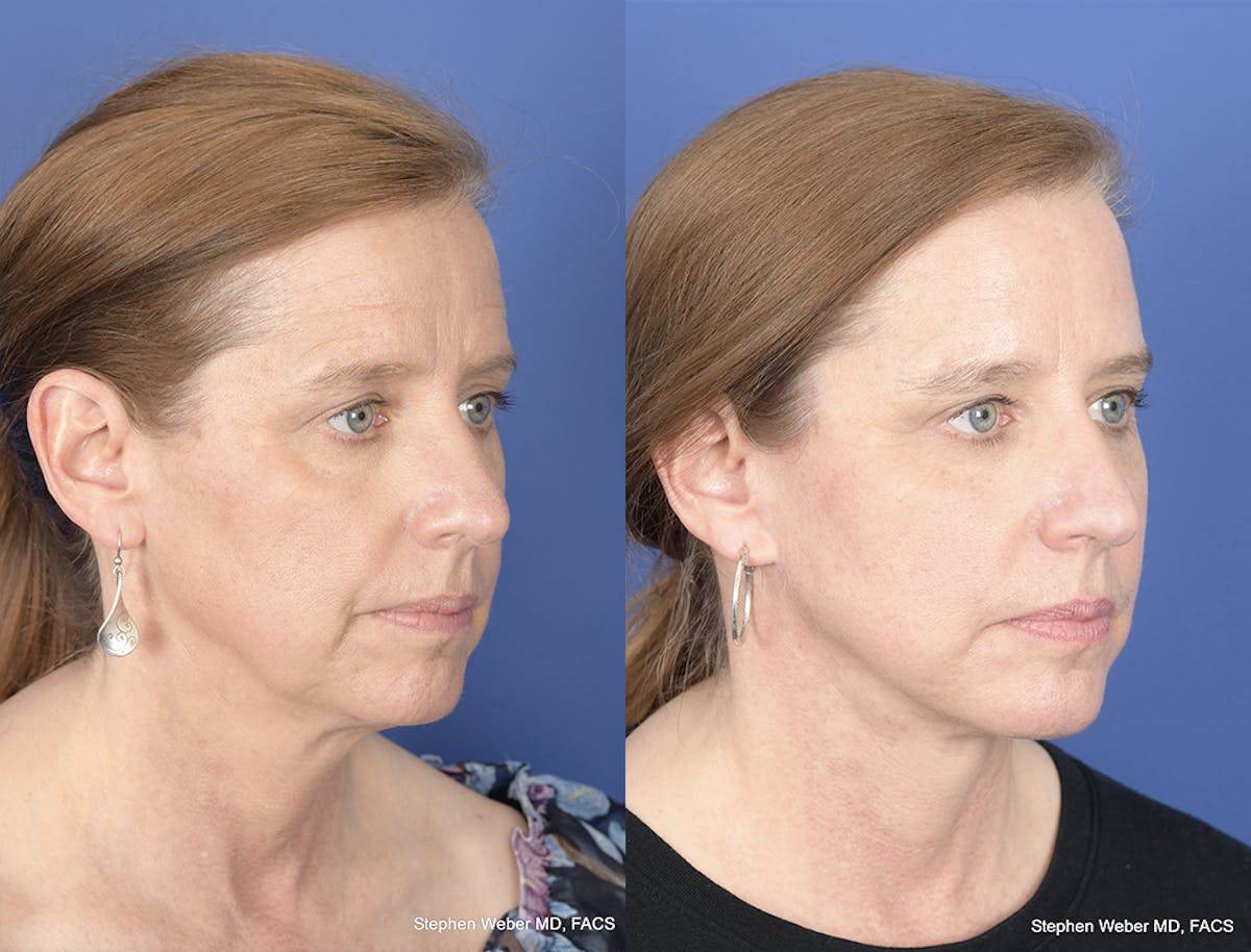 Facelift Before & After Gallery - Patient 700405 - Image 5