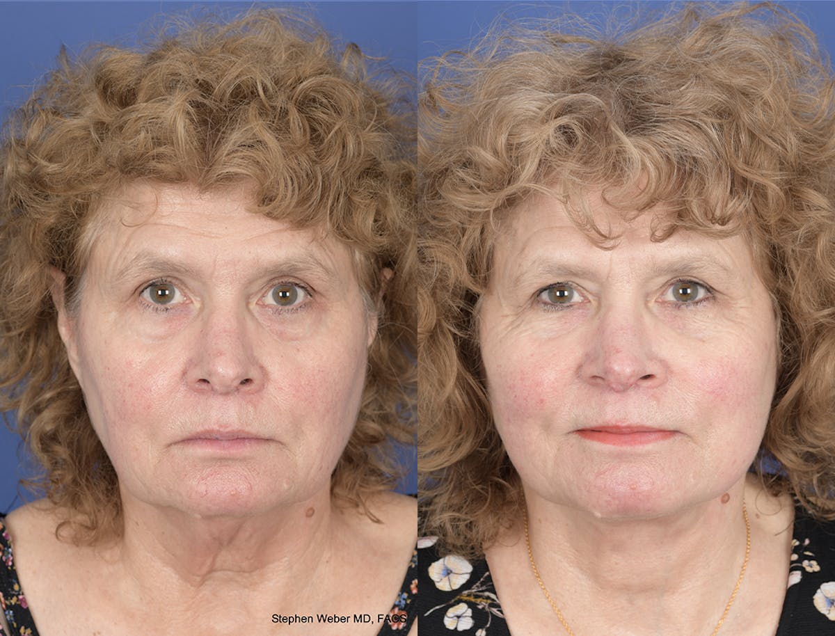 Facelift Before & After Gallery - Patient 374761 - Image 1