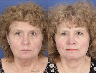 Facelift Before & After Gallery - Patient 374761 - Image 1