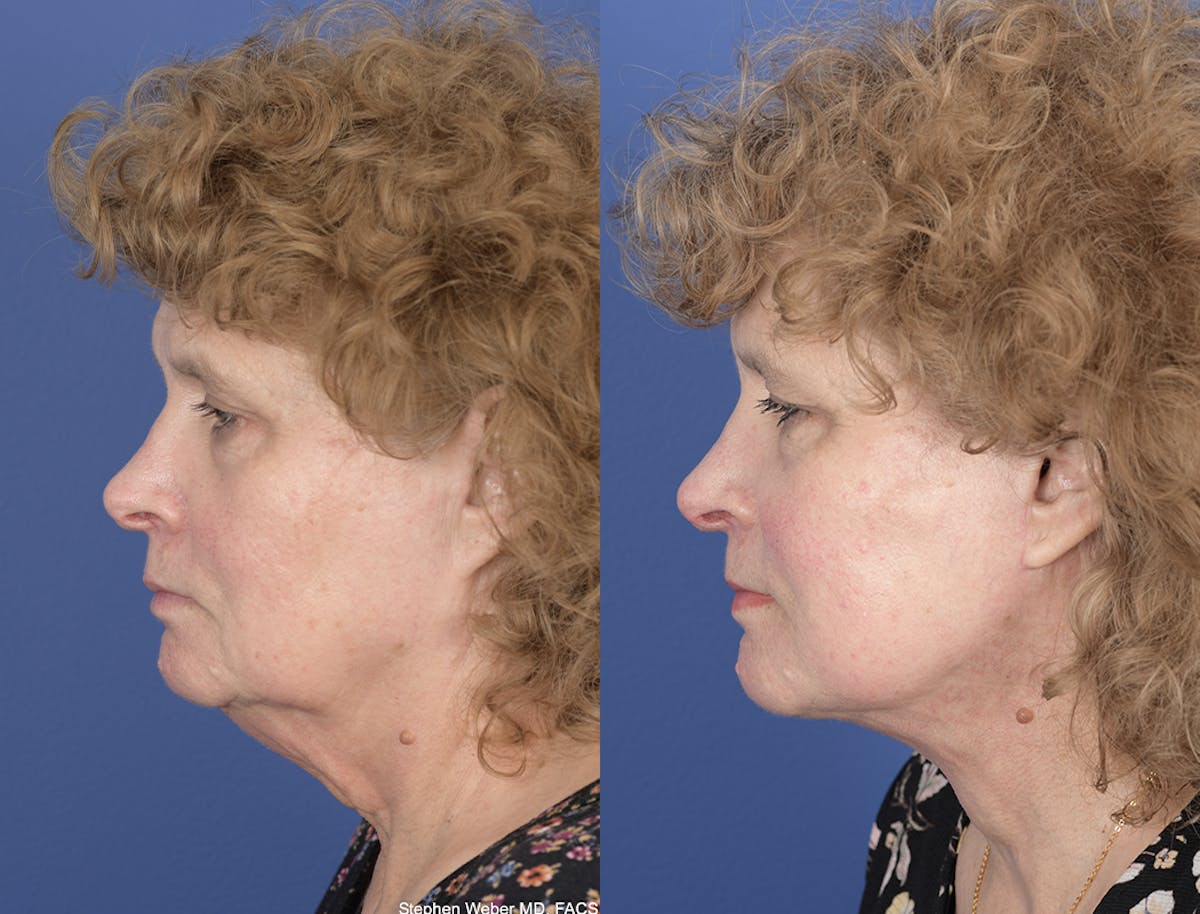 Facelift Before & After Gallery - Patient 374761 - Image 2