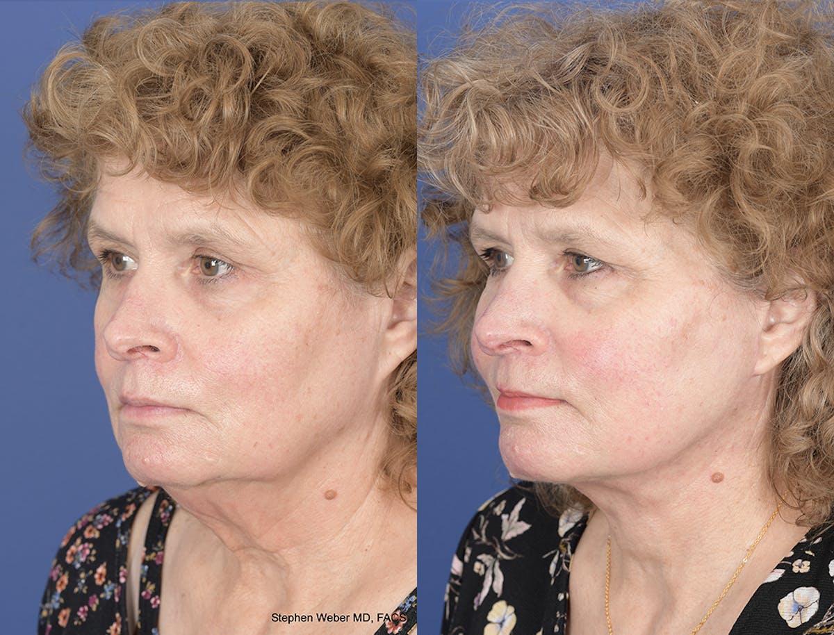 Facelift Before & After Gallery - Patient 374761 - Image 3