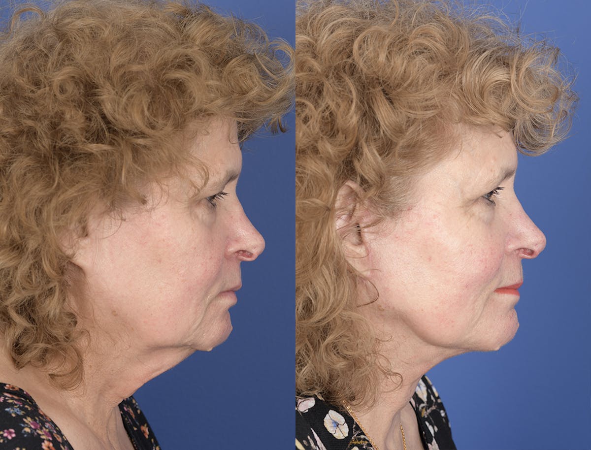 Facelift Before & After Gallery - Patient 374761 - Image 4