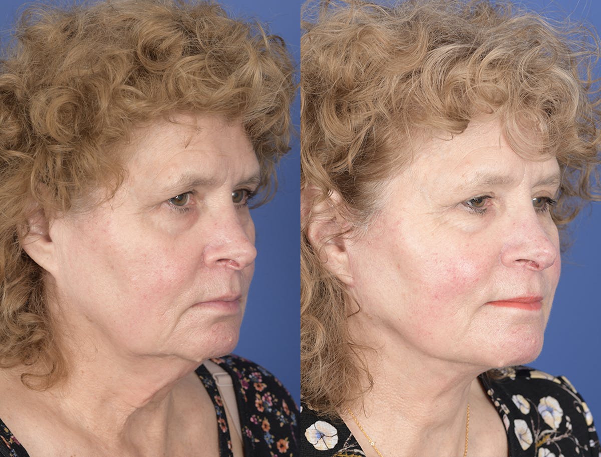 Facelift Before & After Gallery - Patient 374761 - Image 5