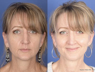Facelift Before & After Gallery - Patient 149655 - Image 1