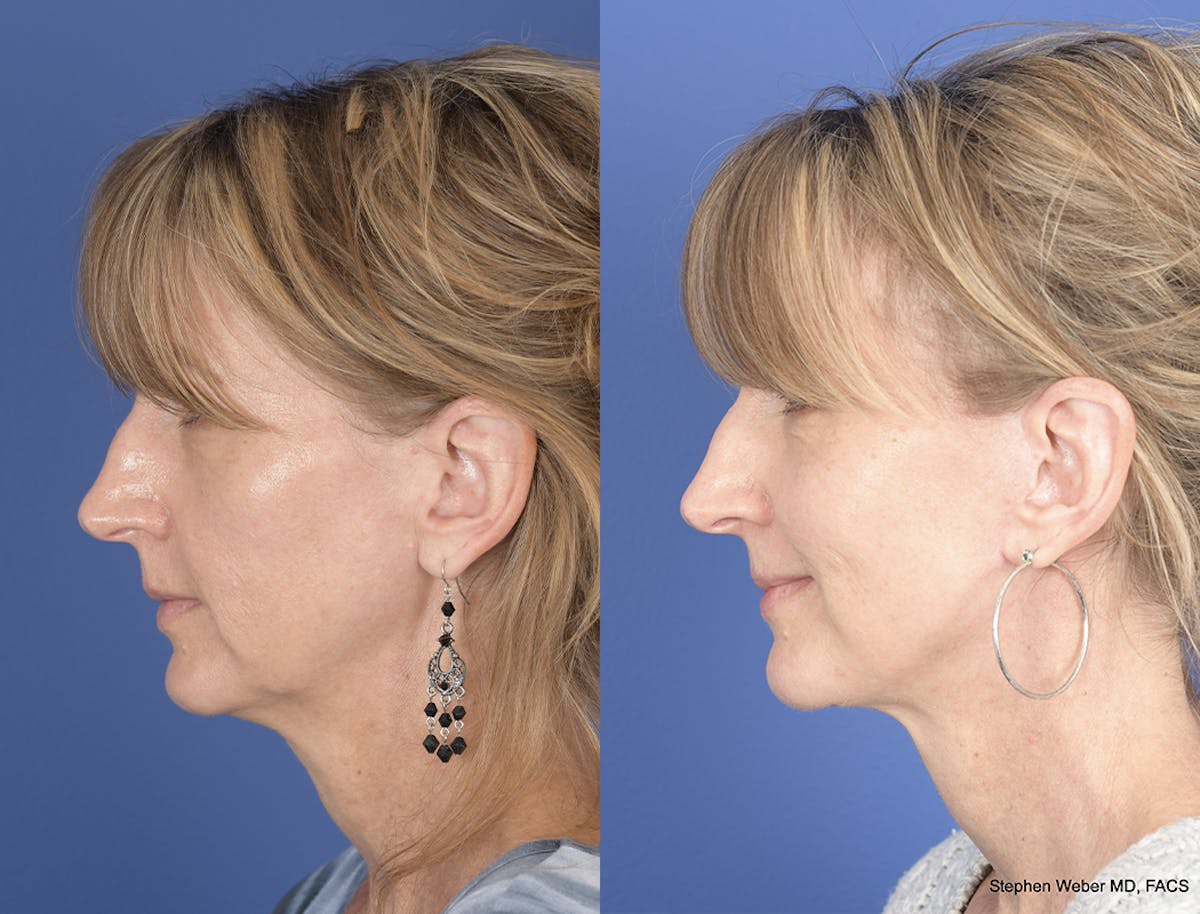 Facelift Before & After Gallery - Patient 149655 - Image 2