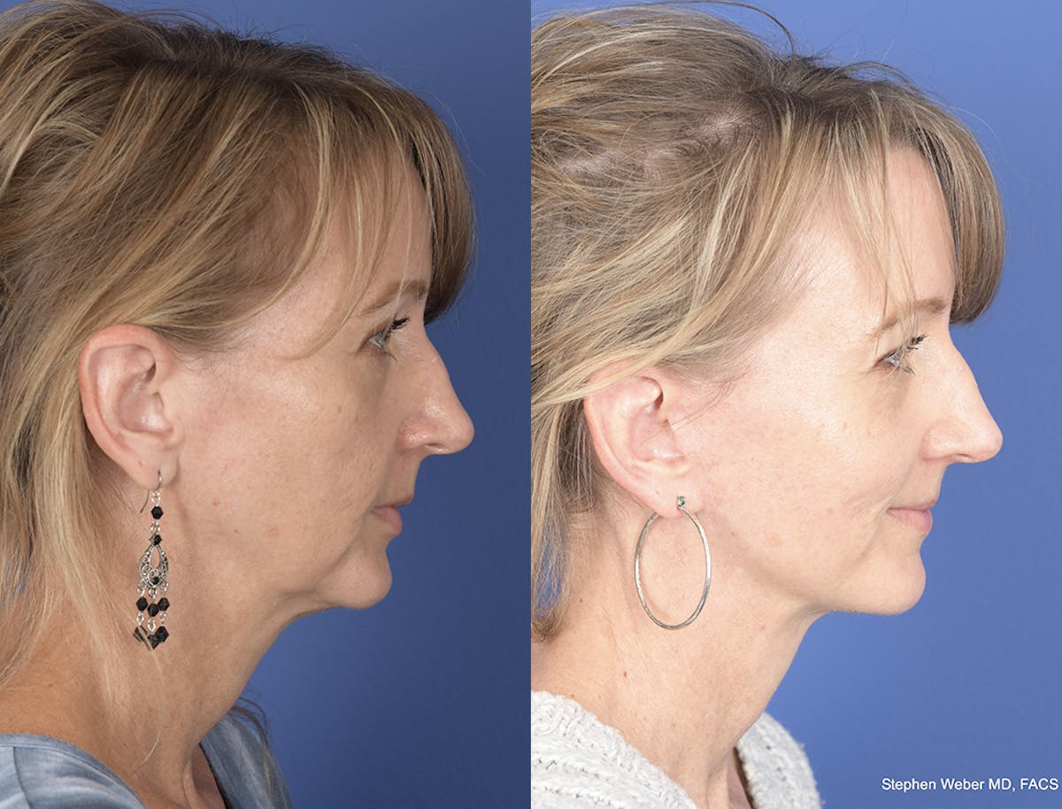 Facelift Before & After Gallery - Patient 149655 - Image 4