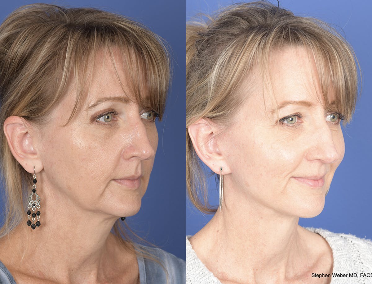 Facelift Before & After Gallery - Patient 149655 - Image 5