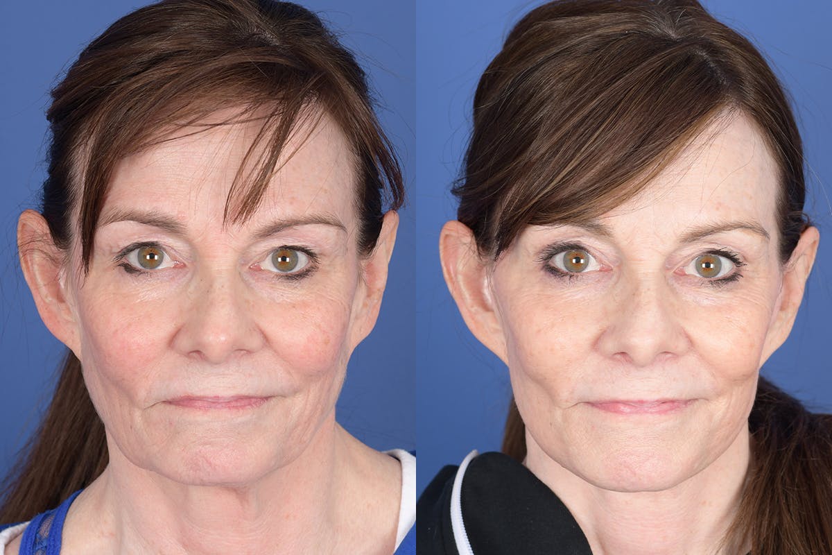 Facelift Before & After Gallery - Patient 422446 - Image 1