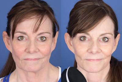 Facelift Before & After Gallery - Patient 422446 - Image 1