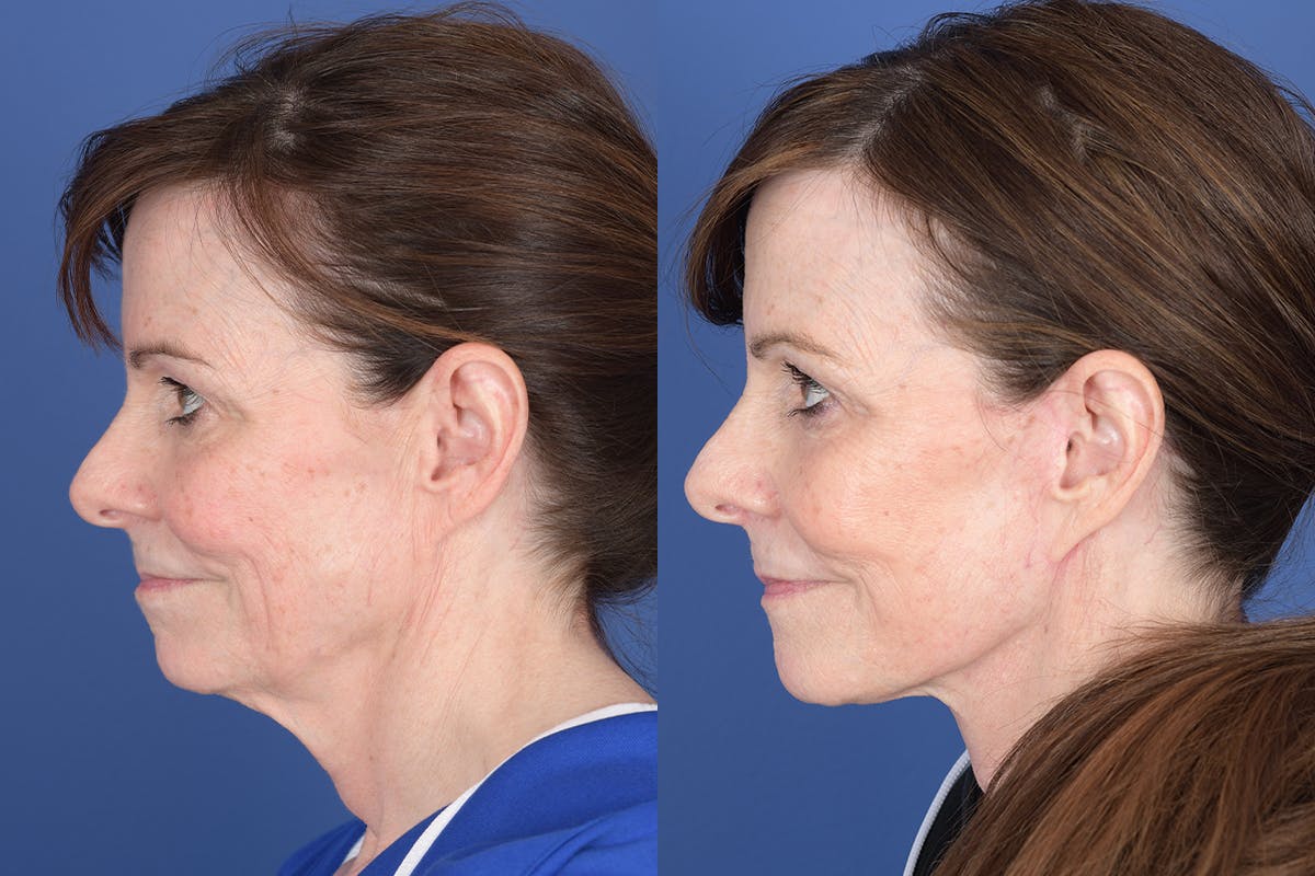 Facelift Before & After Gallery - Patient 422446 - Image 2