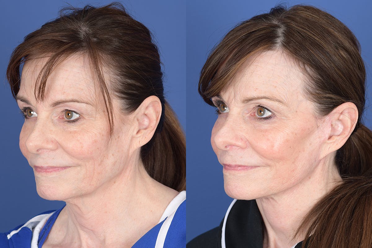 Facelift Before & After Gallery - Patient 422446 - Image 3