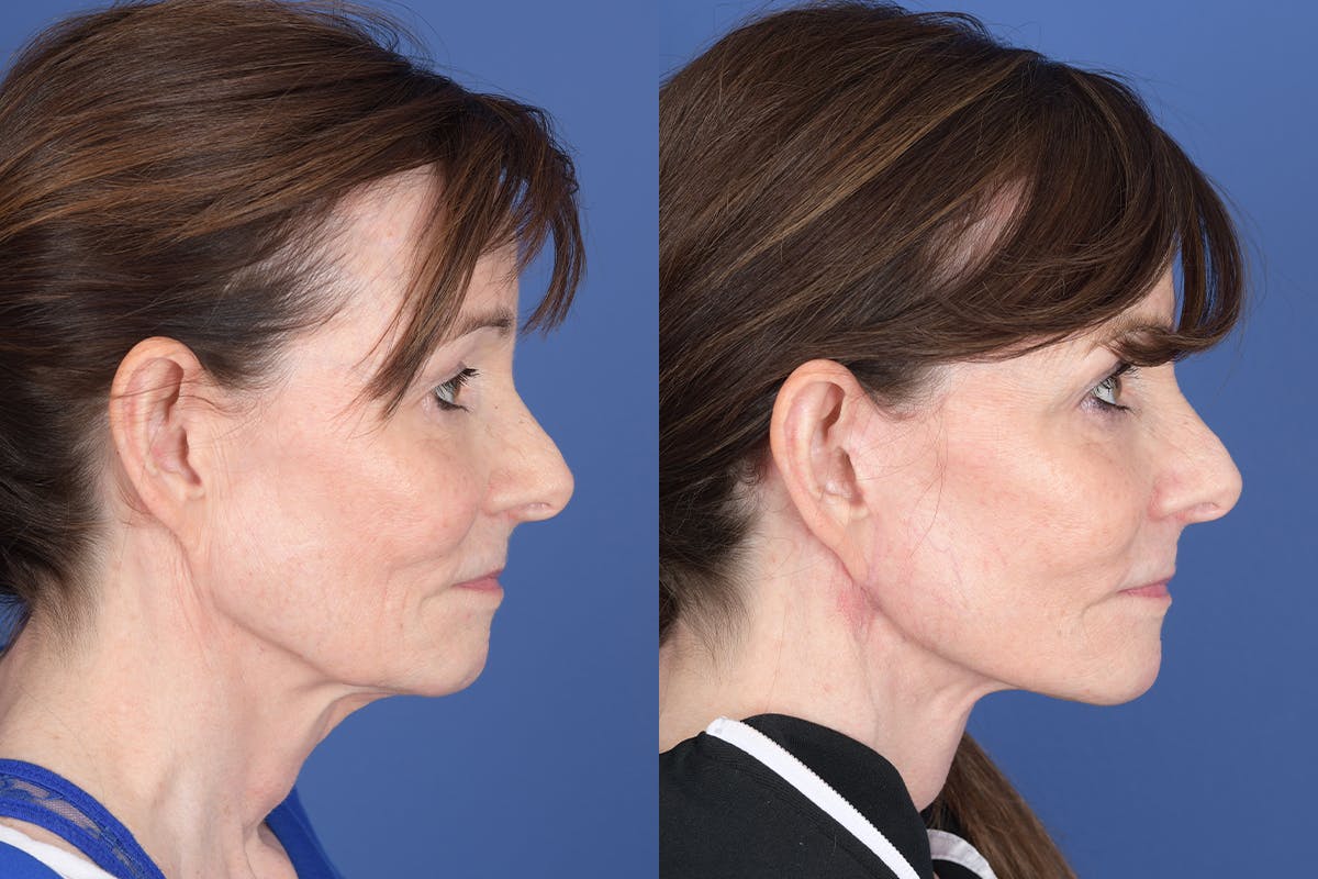 Facelift Before & After Gallery - Patient 422446 - Image 5
