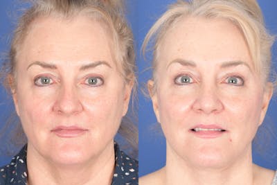 Facelift Before & After Gallery - Patient 154901 - Image 1