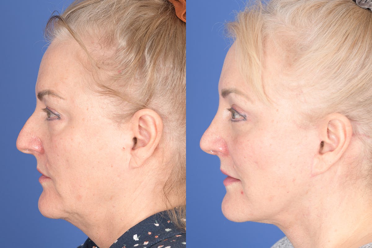 Facelift Before & After Gallery - Patient 154901 - Image 2