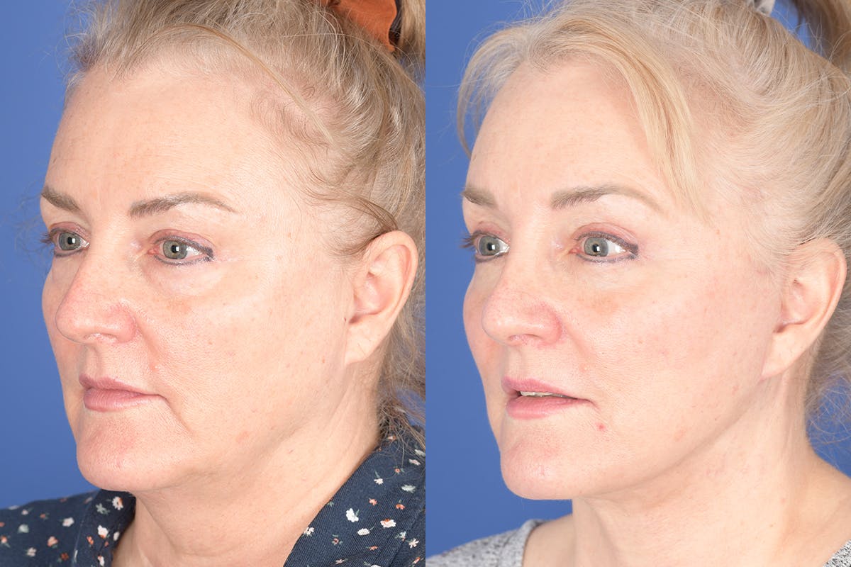 Facelift Before & After Gallery - Patient 154901 - Image 3
