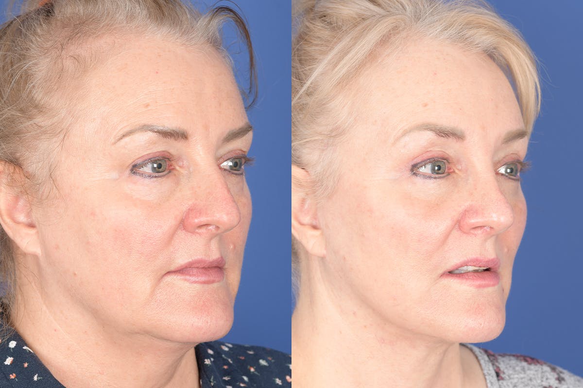 Facelift Before & After Gallery - Patient 154901 - Image 4