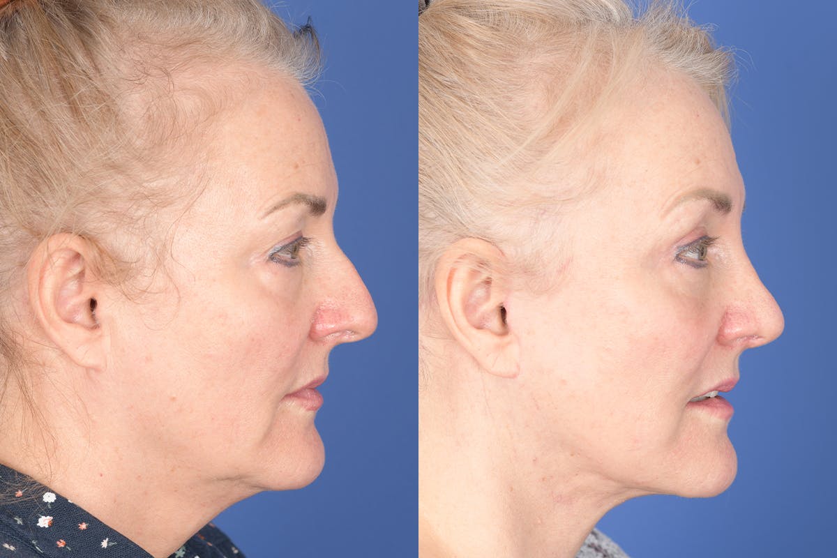 Facelift Before & After Gallery - Patient 154901 - Image 5