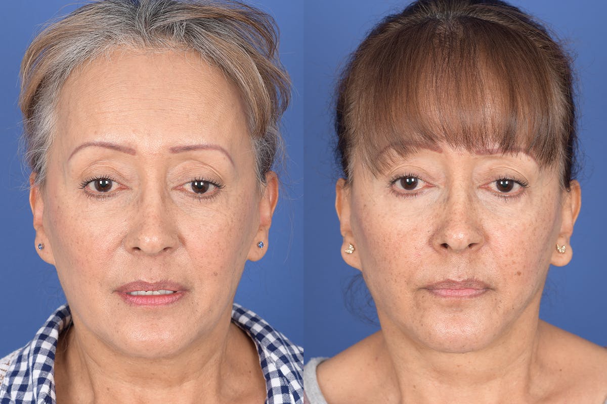 Facelift Before & After Gallery - Patient 155095 - Image 1