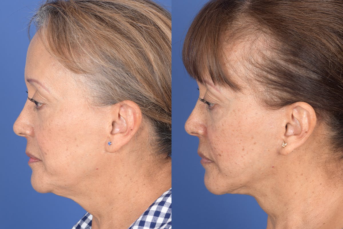 Facelift Before & After Gallery - Patient 155095 - Image 2