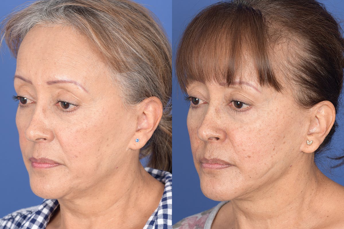 Facelift Before & After Gallery - Patient 155095 - Image 3