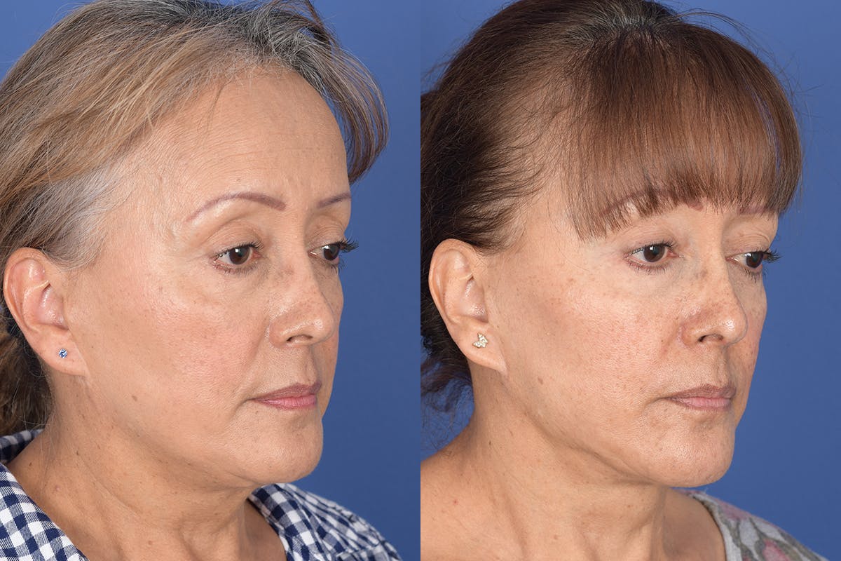 Facelift Before & After Gallery - Patient 155095 - Image 4