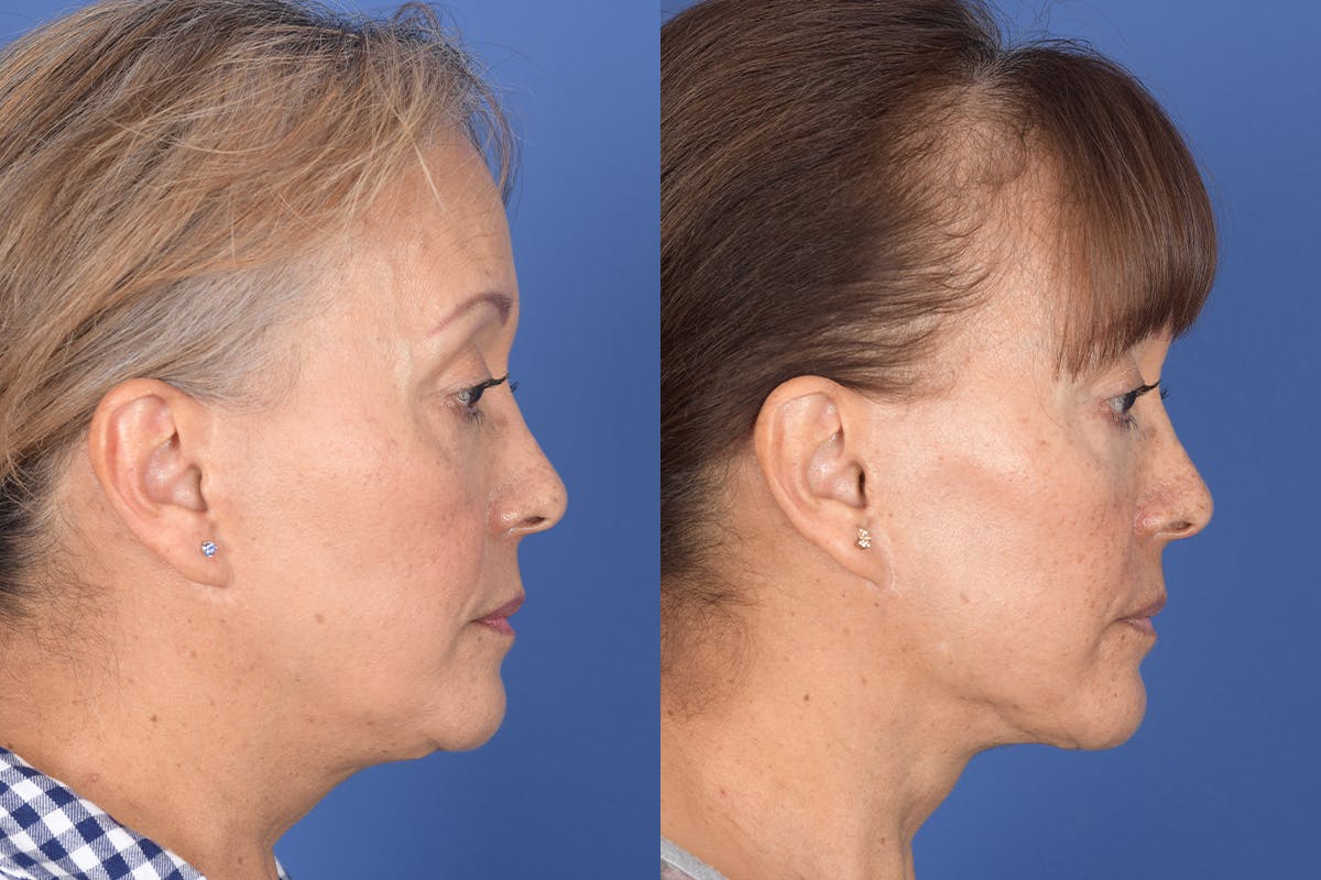 Facelift Before & After Gallery - Patient 155095 - Image 5