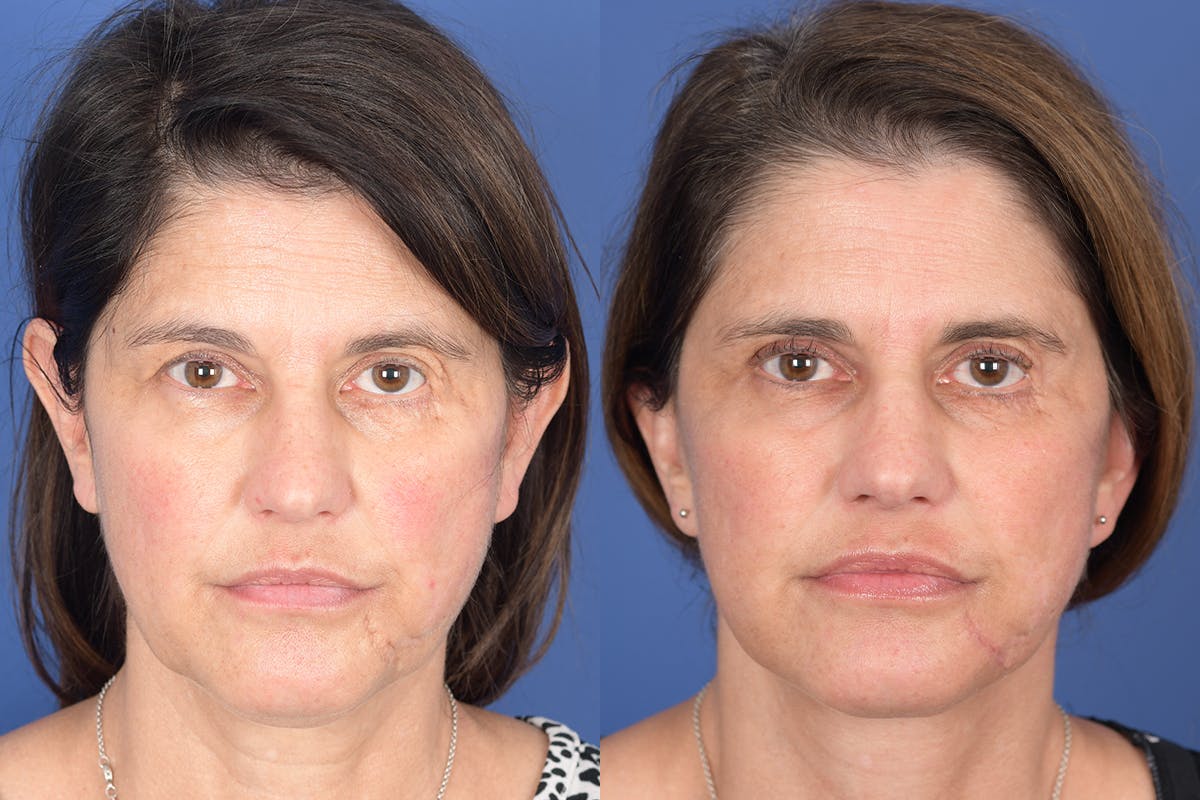 Facelift Before & After Gallery - Patient 245748 - Image 1