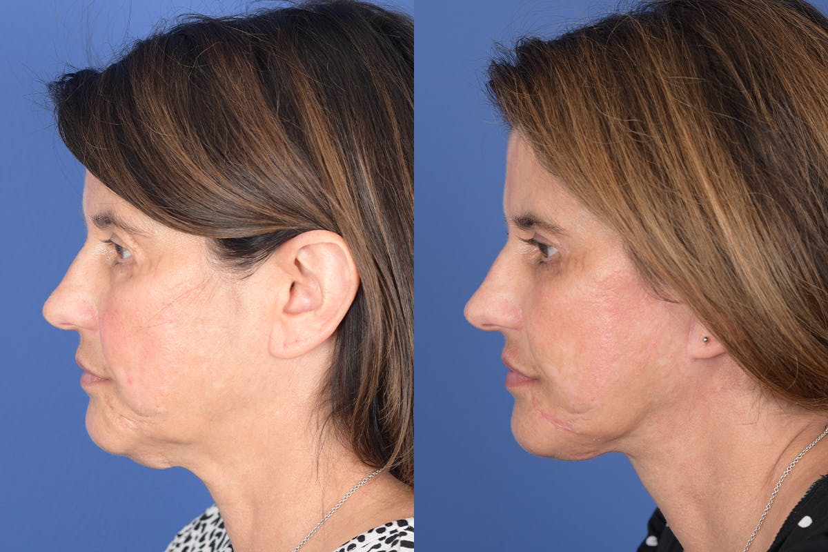 Facelift Before & After Gallery - Patient 245748 - Image 2