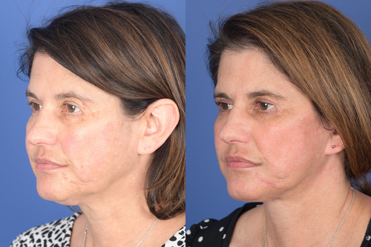 Facelift Before & After Gallery - Patient 245748 - Image 3