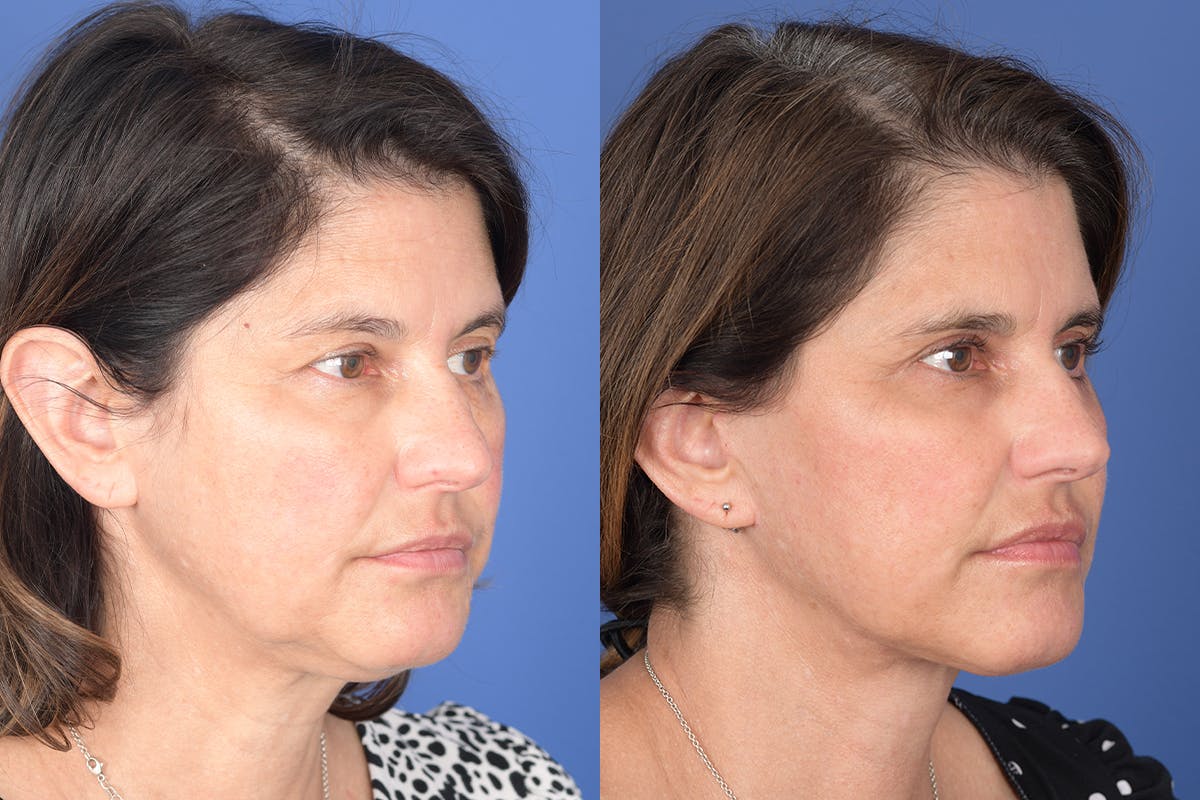 Facelift Before & After Gallery - Patient 245748 - Image 4