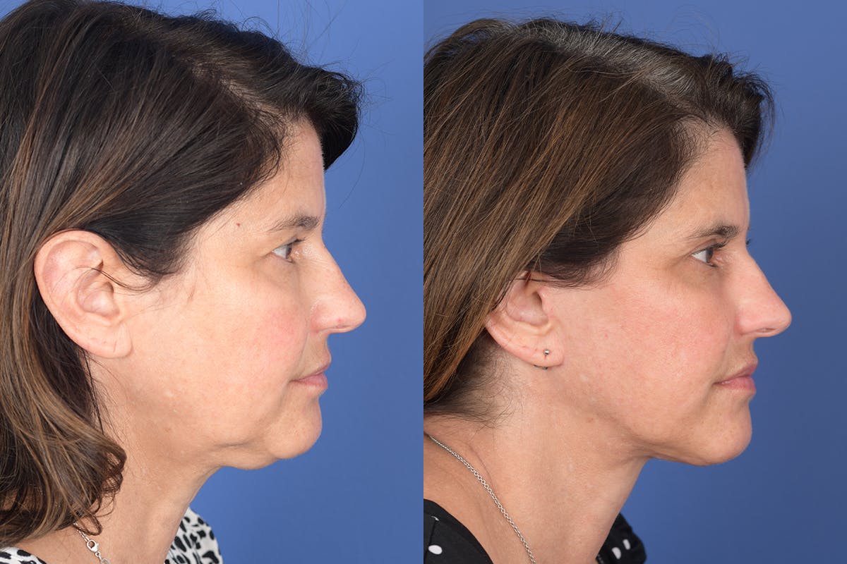 Facelift Before & After Gallery - Patient 245748 - Image 5