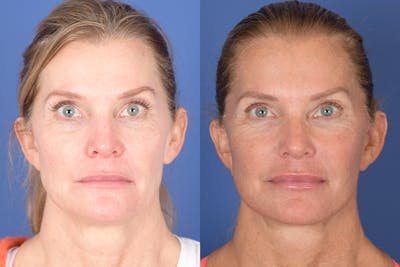 Facelift Before & After Gallery - Patient 343048 - Image 1