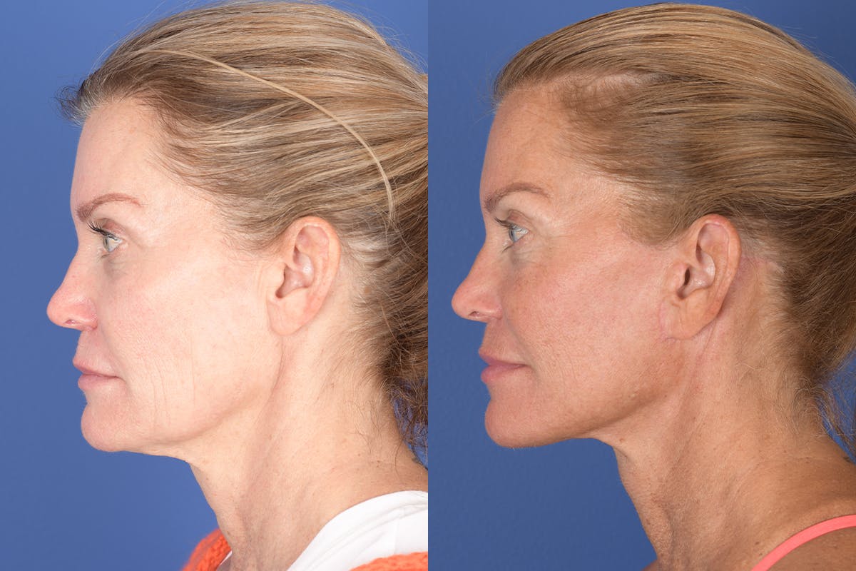 Facelift Before & After Gallery - Patient 343048 - Image 2