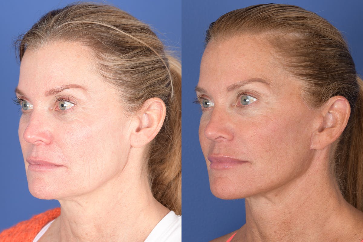 Facelift Before & After Gallery - Patient 343048 - Image 3