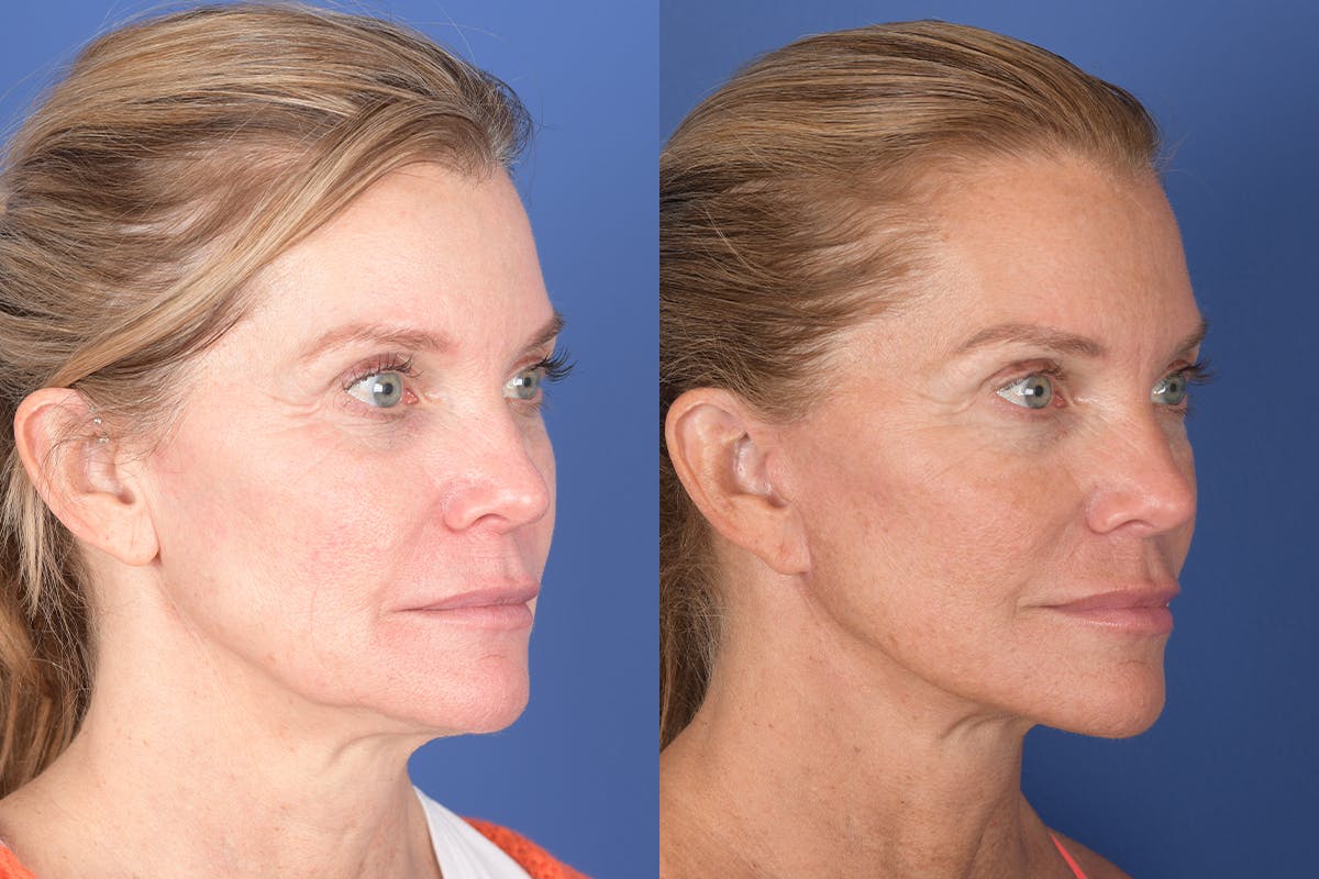 Facelift Before & After Gallery - Patient 343048 - Image 4