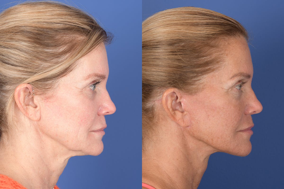 Facelift Before & After Gallery - Patient 343048 - Image 5