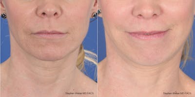 Facelift Before & After Gallery - Patient 343325 - Image 1
