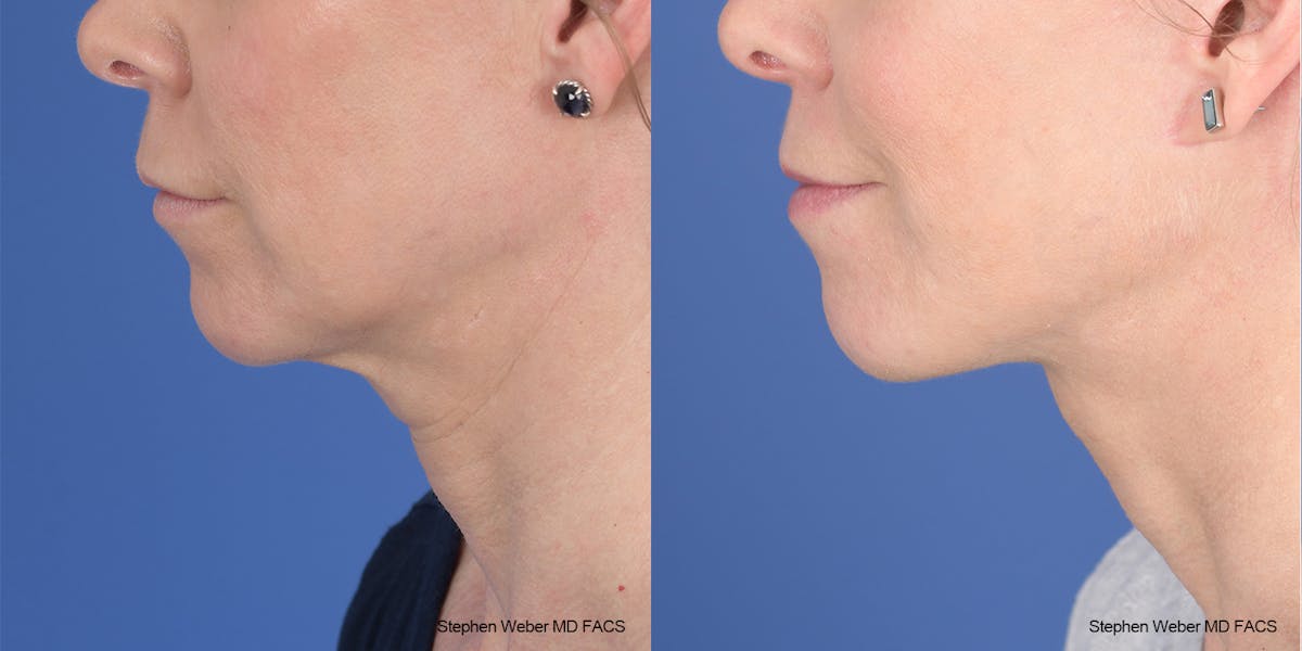 Facelift Before & After Gallery - Patient 343325 - Image 2