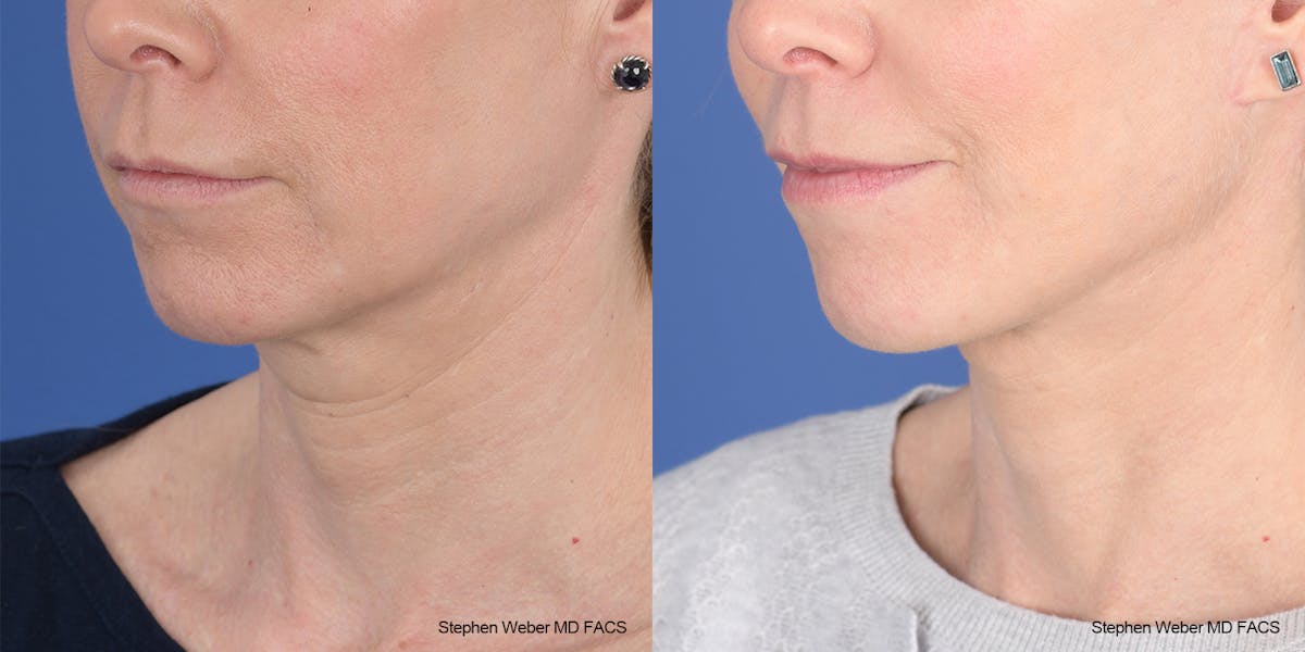 Facelift Before & After Gallery - Patient 343325 - Image 3